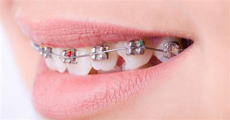 swallowing braces bracket